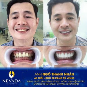 Hình ảnh bọc 20 răng sứ Venus của KH Ngô Thanh Nhàn – Ca 108