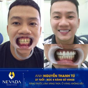 Hình ảnh bọc 8 răng sứ Venus của KH Nguyễn Thanh Tú - Ca 109