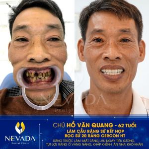 Hình ảnh làm cầu răng sứ kết hợp bọc sứ của KH Hồ Văn Quang – Ca 110