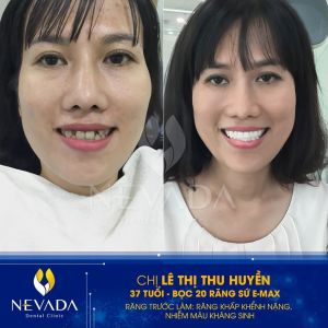 Hình ảnh bọc răng sứ của KH Lê Thị Thu Huyền – Ca 111
