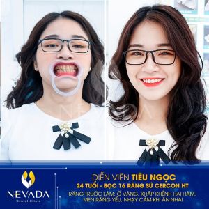 Hình ảnh bọc 16 răng sứ Cercon HT của KH Tiêu Ngọc – Ca 112