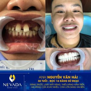Hình ảnh bọc 16 răng sứ E-max của KH Nguyễn Văn Hải – Ca 114