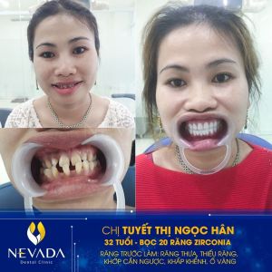 Hình ảnh bọc 20 răng sứ Zirconia của KH Tuyết Thị Ngọc Hân – Ca 116