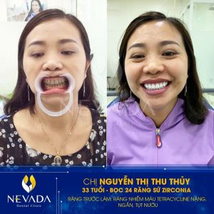 Hình ảnh bọc răng sứ của KH Nguyễn Thị Thu Thủy – Ca 117