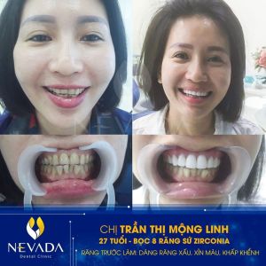 Hình ảnh bọc 8 răng sứ Zirconia của KH Trần Thị Mộng Linh – Ca 118