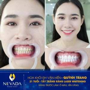 Hình ảnh tẩy trắng răng của KH Quỳnh Trang – Ca 119