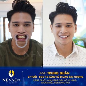 Hình ảnh bọc răng sứ của KH Trung Quân – Ca 120