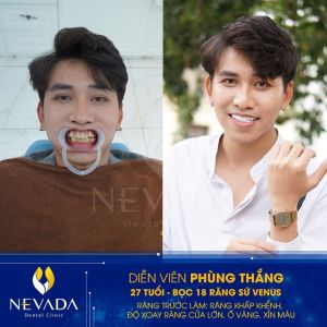 Hình ảnh bọc răng sứ của KH Phùng Thắng – Ca 121