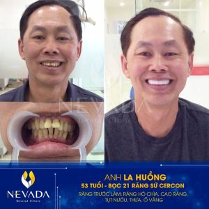 Hình ảnh bọc răng sứ của KH La Huồng – Ca 122