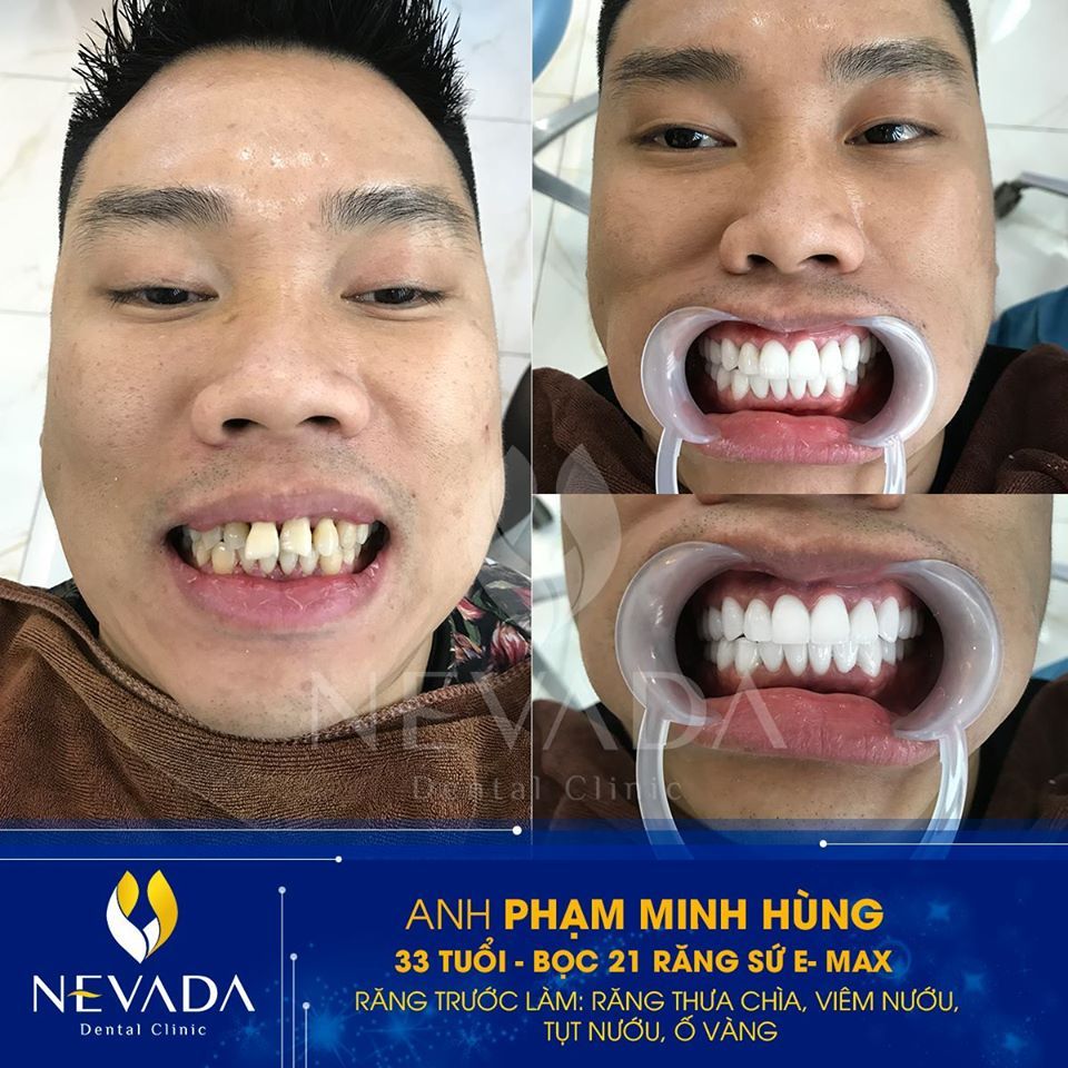 Hình ảnh Bọc răng sứ: Hình ảnh bọc 21 răng sứ E-max của KH Phạm ...