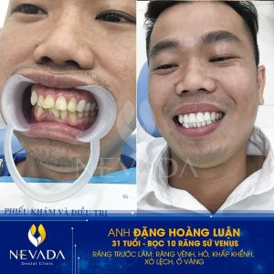 Hình ảnh bọc răng sứ Venus của KH Đặng Hoàng Luận – Ca 124