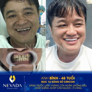 Hình ảnh bọc 18 răng sứ Cercon của anh Bình (48 tuổi) – Ca 126