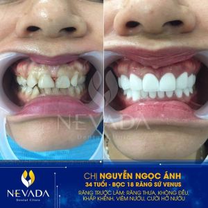 Hình ảnh bọc răng sứ của KH Nguyễn Ngọc Ánh - Ca 127