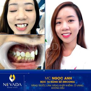 Hình ảnh bọc 16 răng sứ Zirconia của KH Ngọc Anh – Ca 128