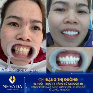 Hình ảnh bọc 14 răng sứ Cercon HT của KH Đặng Thị Đường – Ca 129