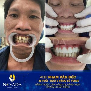 Hình ảnh bọc 8 răng sứ Venus của KH Phạm Văn Đức – Ca 130