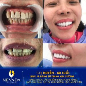 Hình ảnh bọc răng sứ D-mag kim cương của chị Huyền – Ca 131