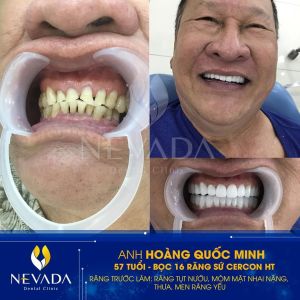 Hình ảnh bọc răng sứ Cercon HT của KH Hoàng Quốc Minh – Ca 132