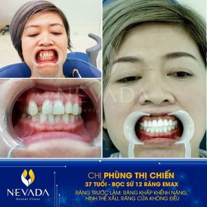 Hình ảnh bọc 12 răng sứ Emax của KH Phùng Thị Chiến – Ca 133