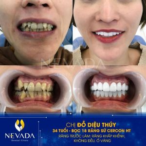 Hình ảnh bọc 18 răng sứ Cercon HT của KH Đỗ Diệu Thúy - Ca 134