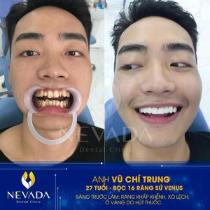 Hình ảnh bọc 16 răng sứ Venus của KH Vũ Chí Trung – Ca 135