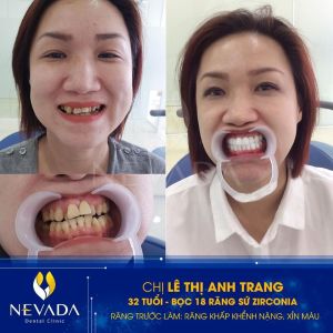 Hình ảnh bọc 18 răng sứ Zirconia của KH Lê Thị Anh Trang - Ca 136