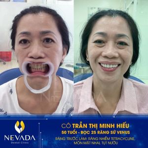Hình ảnh bọc 25 răng sứ Venus của KH Trần Thị Minh Hiếu – Ca 137
