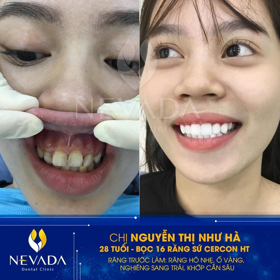 Hình ảnh Bọc răng sứ: Hình ảnh bọc răng sứ Cercon HT của KH Nguyễn ...