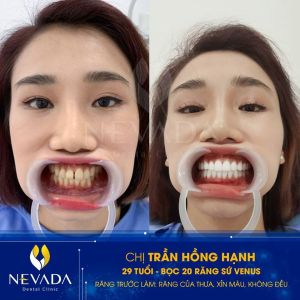 Hình ảnh bọc 20 răng sứ Venus của KH Trần Hồng Hạnh – Ca 139