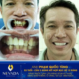 Hình ảnh làm cầu răng kết hợp bọc răng sứ của KH Phạm Quốc Tùng – Ca 140