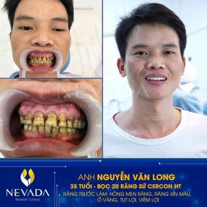 Hình ảnh bọc 20 răng sứ Cercon HT của KH Nguyễn Văn Long – Ca 141