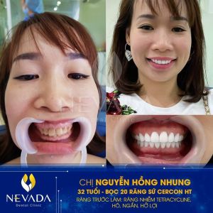 Hình ảnh bọc 20 răng sứ Cercon HT của KH Nguyễn Hồng Nhung – Ca 142