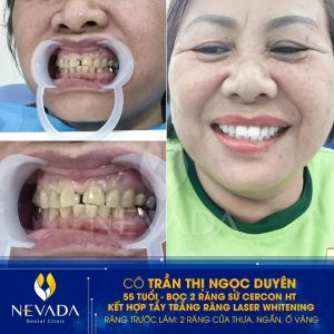 Hình ảnh bọc răng sứ kết hợp tẩy trắng răng của KH Trần Thị Ngọc Duyên – Ca 143