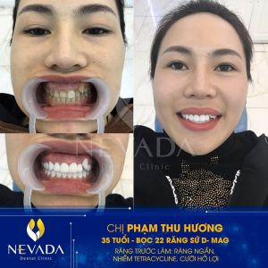 Hình ảnh bọc 22 răng sứ của KH Phạm Thu Hương – Ca 144