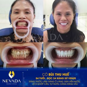 Hình ảnh bọc 24 răng sứ Venus của KH Bùi Thu Huế - Ca 145