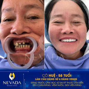 Hình ảnh làm cầu răng sứ 6 răng venus của cô Huệ - Ca 146