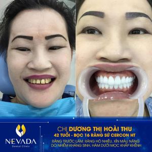Hình ảnh bọc 16 răng sứ Cercon HT của KH Dương Thị Hoài Thu – Ca 147