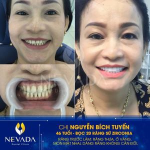 Hình ảnh bọc 20 răng sứ Zirconia của KH Nguyễn Bích Tuyến – Ca 148