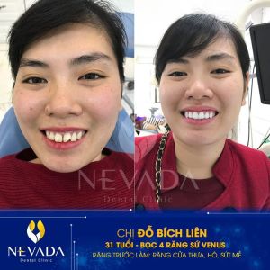 Hình ảnh bọc răng sứ của KH Đỗ Bích Liên – Ca 149