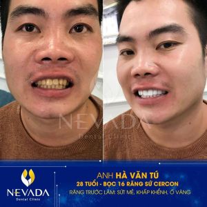 Hình ảnh bọc răng sứ của KH Hà Văn Tú – Ca 152