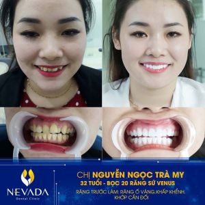 Hình ảnh bọc 20 răng sứ Venus của KH Nguyễn Ngọc Trà My - Ca 153