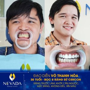 Hình ảnh bọc 8 răng sứ cercon của KH Võ Thanh Hòa – Ca 155