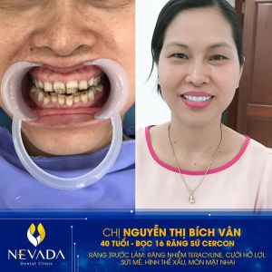 Hình ảnh bọc 16 răng sứ Cercon của KH Nguyễn Thị Bích Vân – Ca 156