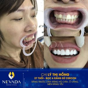 Hình ảnh bọc 6 răng sứ Cercon của KH Lý Thị Hồng – Ca 157