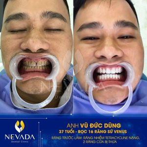 Hình ảnh bọc 16 răng sứ Venus của KH Vũ Đức Dũng – Ca 158
