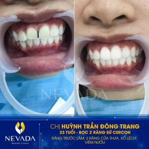 Hình ảnh bọc 2 răng sứ Cercon của KH Huỳnh Trần Đông Trang – Ca 159