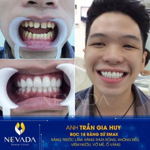 Hình ảnh bọc 18 răng sứ Emax của KH Trần Gia Huy – Ca 67