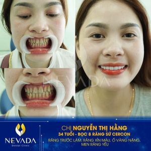 Hình ảnh bọc 8 răng sứ Cercon của KH Nguyễn Thị Hằng – Ca 68