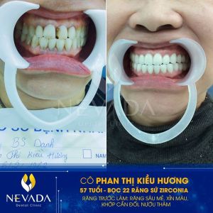 Hình ảnh bọc 22 răng sứ Zirconia của KH Phan Thị Kiều Hương – Ca 69