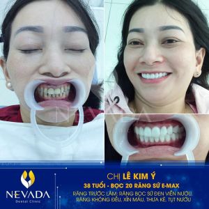 Hình ảnh bọc răng sứ của KH Lê Kim Ý - Ca 70